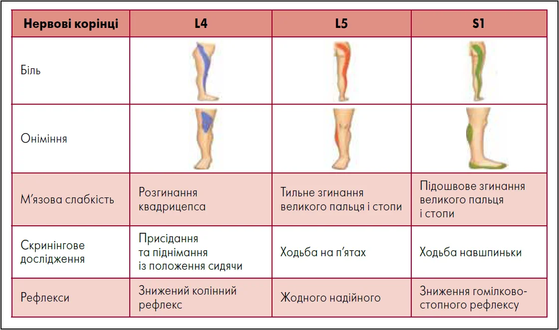 Рис. 2. Тестування на визначення ураження поперекових нервових корінців
